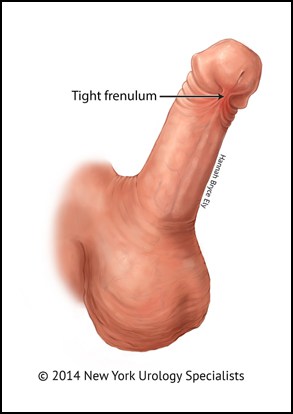 Frenulectomy Procedure Dallas