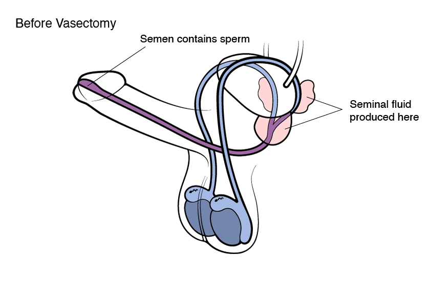 Before Vasectomy Animation